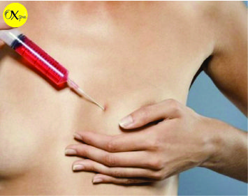 OXspa, Các phương pháp nâng ngực không cần phẫu thuật