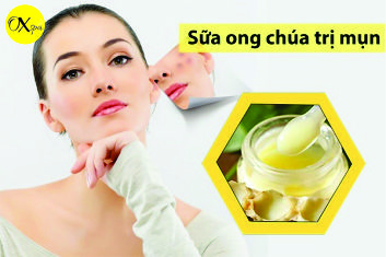 Mặt nạ sữa ong chúa trị mụn 