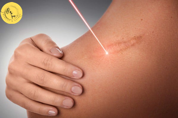 Cách trị sẹo thâm sau laser hiệu quả