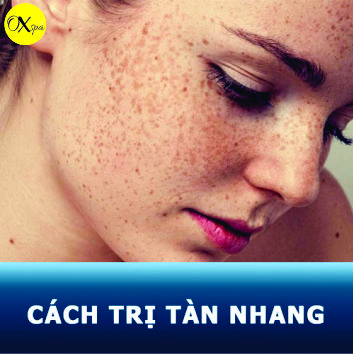 Cách trị tàn nhang trên mặt