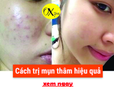 Cách trị thâm mụn hiệu quả, Oxspa