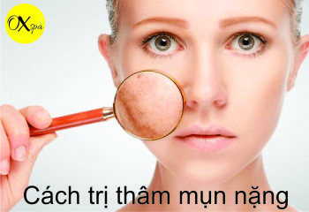 Cách trị thâm mụn nặng