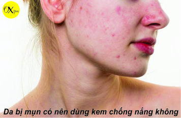 OXspa, Da bị mụn có nên dùng kem chống nắng không