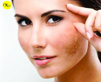 Dấu hiệu của nám da mặt và cách điều trị, Oxspa