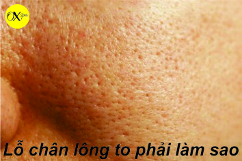 Lỗ chân lông to phải làm sao, oxspa