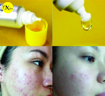 OXspa, Mặt mụn có nên dùng serum không