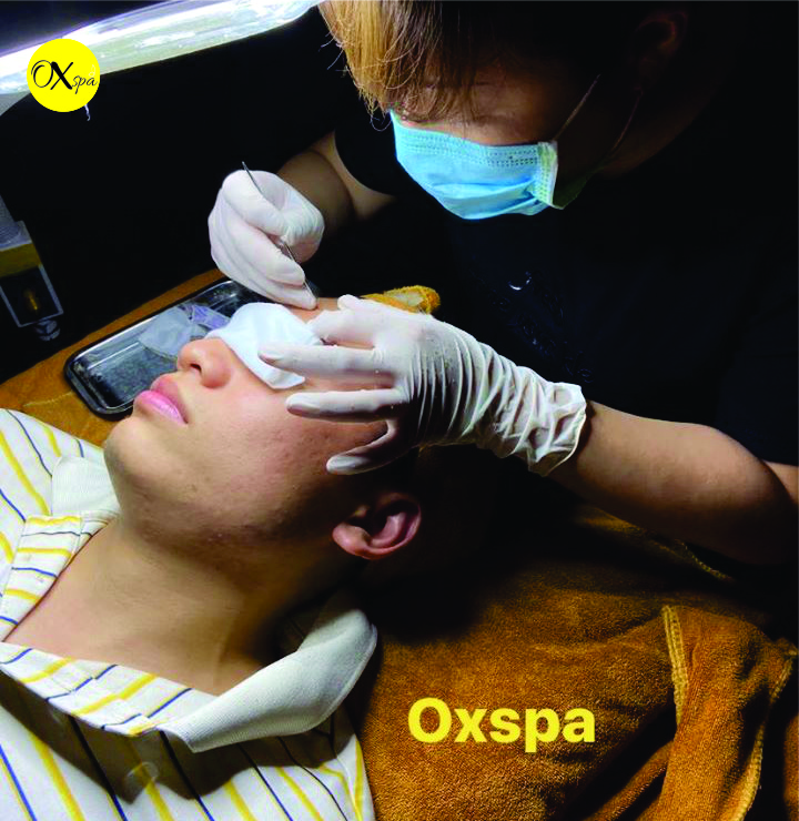 Nên nặn mụn bao lâu một lần, Oxspa