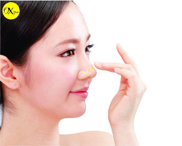 Nên nâng mũi bằng chỉ hay tiêm filler, Oxspa