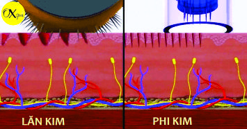 Phi kim khác lăn kim như thế nào, Oxspa