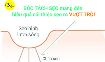 Phương pháp bóc tách đáy sẹo rỗ là gì