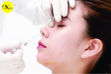 Tiêm filler mũi có thời hạn bao lâu, Oxspa